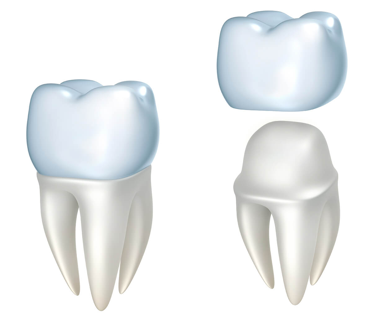 Dental Crowns on Front Teeth in Calgary AB Area