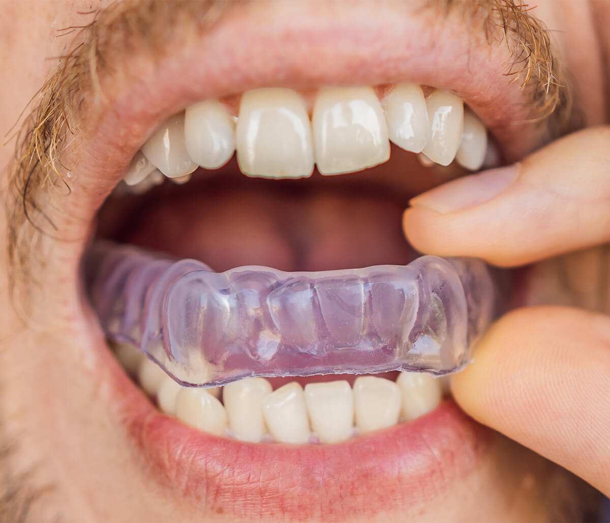 Mouth Splint For Bruxism in Calgary AB Area